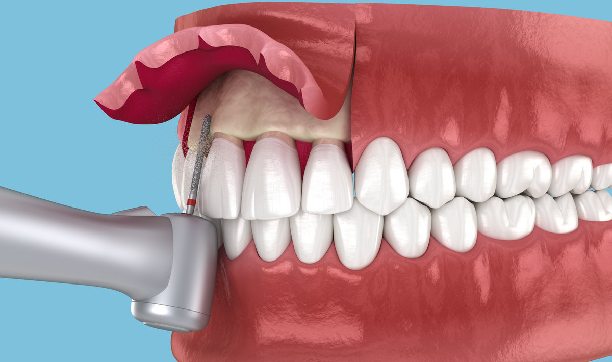 Frontal crown lengthening, Esthetic surgery. 3D illustration